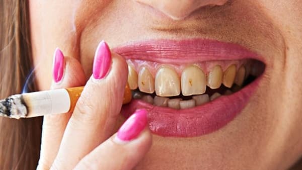 Smoking and oral health