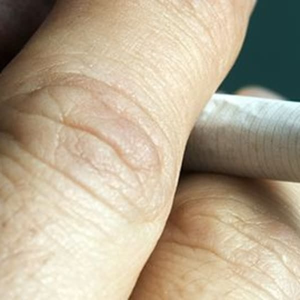 Mouth cancer risk factors