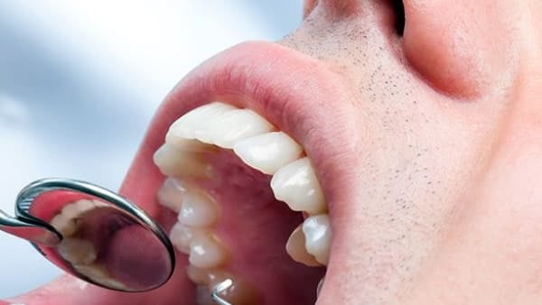 Pit and fissure sealants