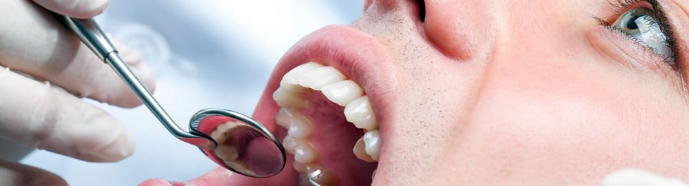 Pit and fissure sealants