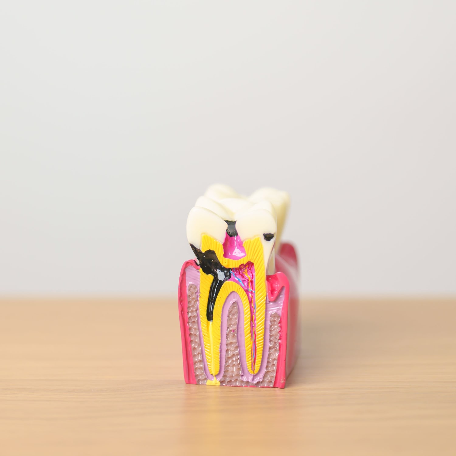 Model of tooth decay