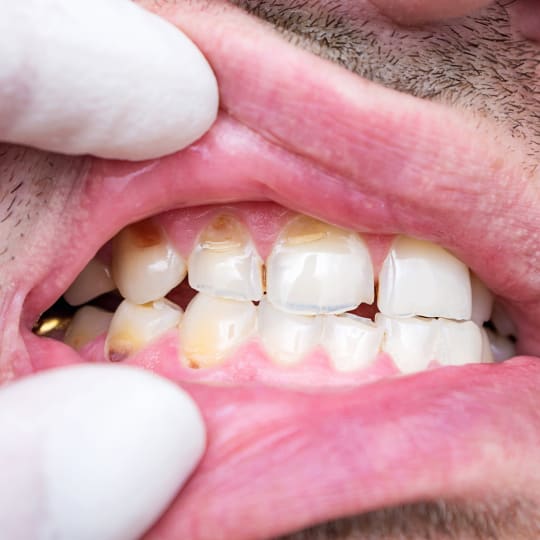 Fingers in clinical gloves gently moving the lip to expose the teeth and gums